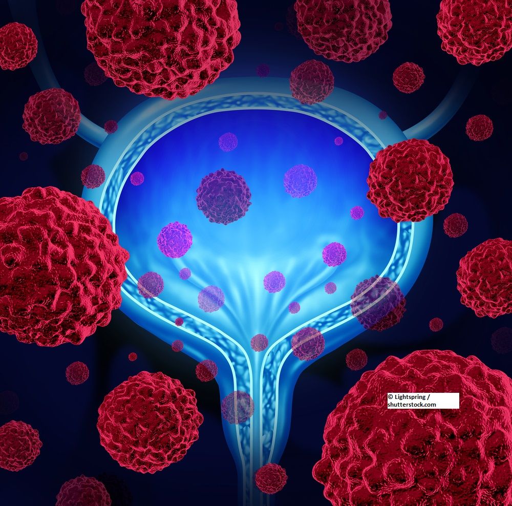 Bladder cancer, bladder tumor, urothelial cancer
