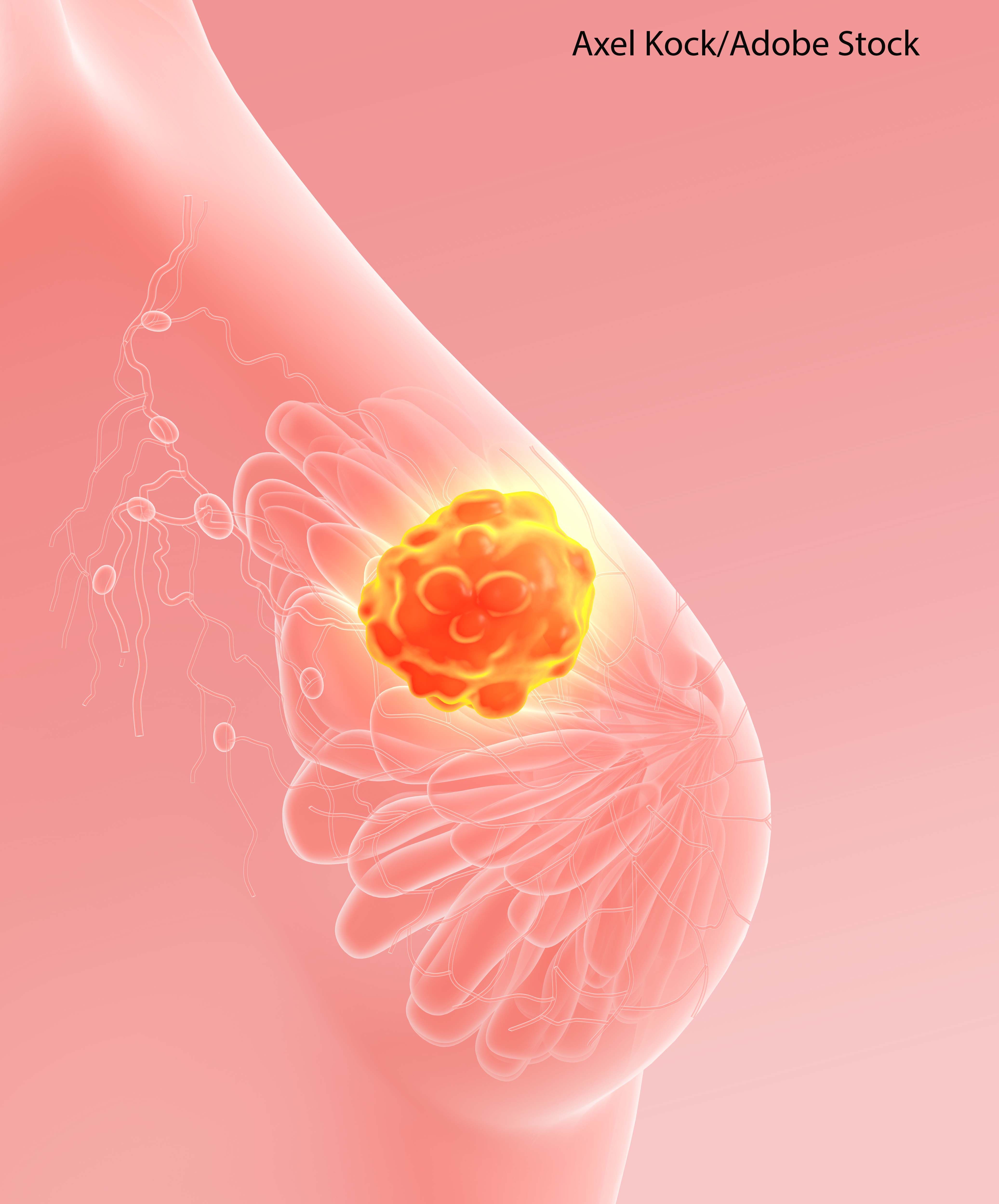 Breast MRI in patients with newly diagnosed breast cancer increased mastectomy rates and biopsy needs.
