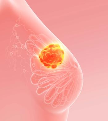 Breast MRI in patients with newly diagnosed breast cancer increased mastectomy rates and biopsy needs.