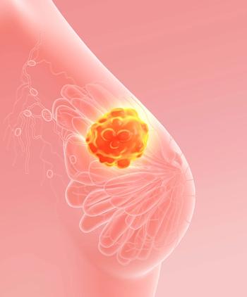 Breast MRI in patients with newly diagnosed breast cancer increased mastectomy rates and biopsy needs.