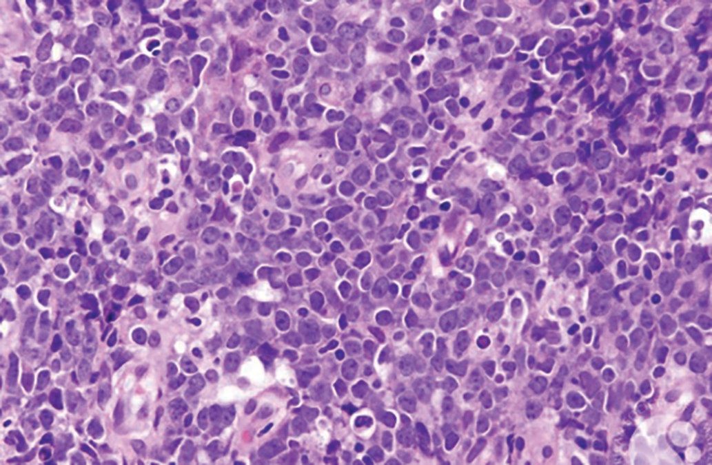 76-Year-Old Woman With a Bluish-Purple Lump in her Left Upper Medial