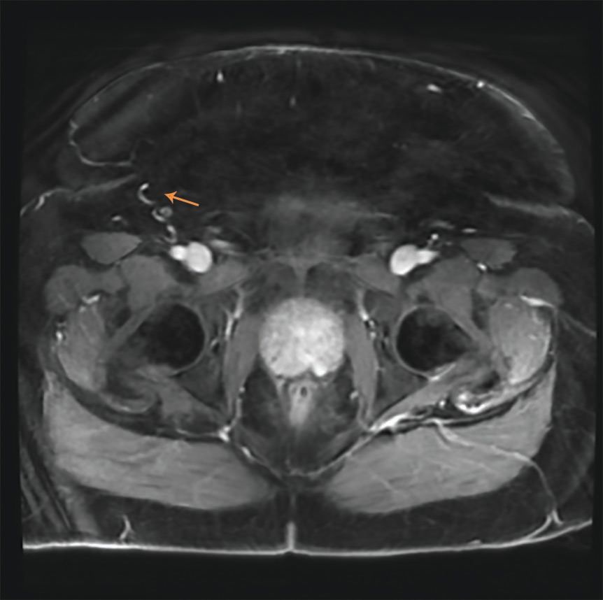 1 cm lesion on prostate, Differentiating Recurrent Brain Tumor Versus Radiation Injury Using MRI