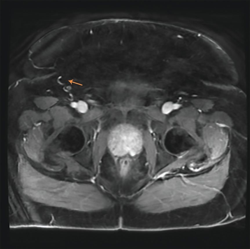 1 cm lesion on prostate