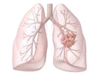 Phase 2 data showed no dose-limiting toxicities with EIK1001 plus pembrolizumab in patients with advanced non–small cell lung cancer.