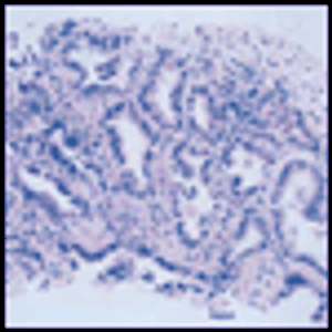 Systemic Approaches for Multifocal Bronchioloalveolar Carcinoma: Is There an Appropriate Target?