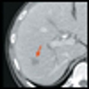 Management of a Patient With Borderline Resectable Pancreatic Cancer
