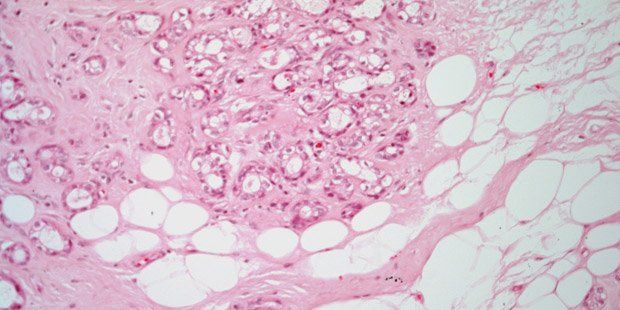 Hard Induration Breast Induration in 42-Year-Old Patient