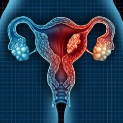 Novel Agent ONA-XR Demonstrates Early Activity in Endometrial Cancer