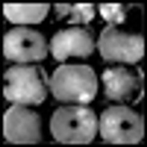 The Absent-Minded Professor: An Unusual Complication of Melanoma