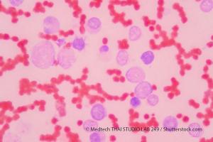 FDA Grants Fast-Track Designation to CX-01 for Acute Myeloid Leukemia