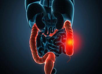 The Emerging Value of ctDNA in Colon Cancer Adjuvant Therapy Decisions