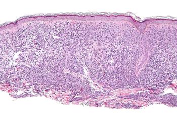 Primary and secondary end points from the phase 2 PIONEER trial assessing avapritinib in nonadvanced systemic mastocytosis were met.