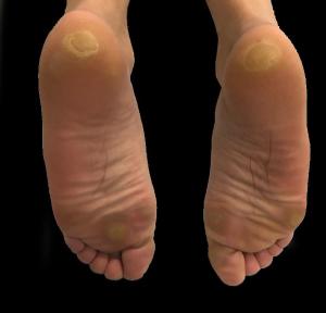 Hand-Foot Skin Reaction Secondary  to Sunitinib in a Patient With Metastatic Clear Cell Renal Cell Carcinoma