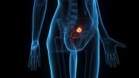 Relacorilant Combo Receives Positive CHMP Opinion in Ovarian Cancer: © Sebastian Kaulitzki - stock.adobe.com