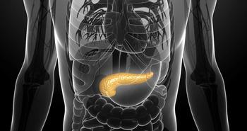 A combination of liposomal irinotecan plus 5-fluorouracil, leucovorin, and oxaliplatin in the frontline yields a statistically significant survival benefit compared with nab-paclitaxel and gemcitabine in a population diagnosed with metastatic pancreatic ductal adenocarcinoma.