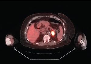 Recurrent EGFR-Mutated Non–Small Cell Lung Cancer Discovered by Abnormal Mammogram: Adjuvant/Frontline Metastatic Management Options