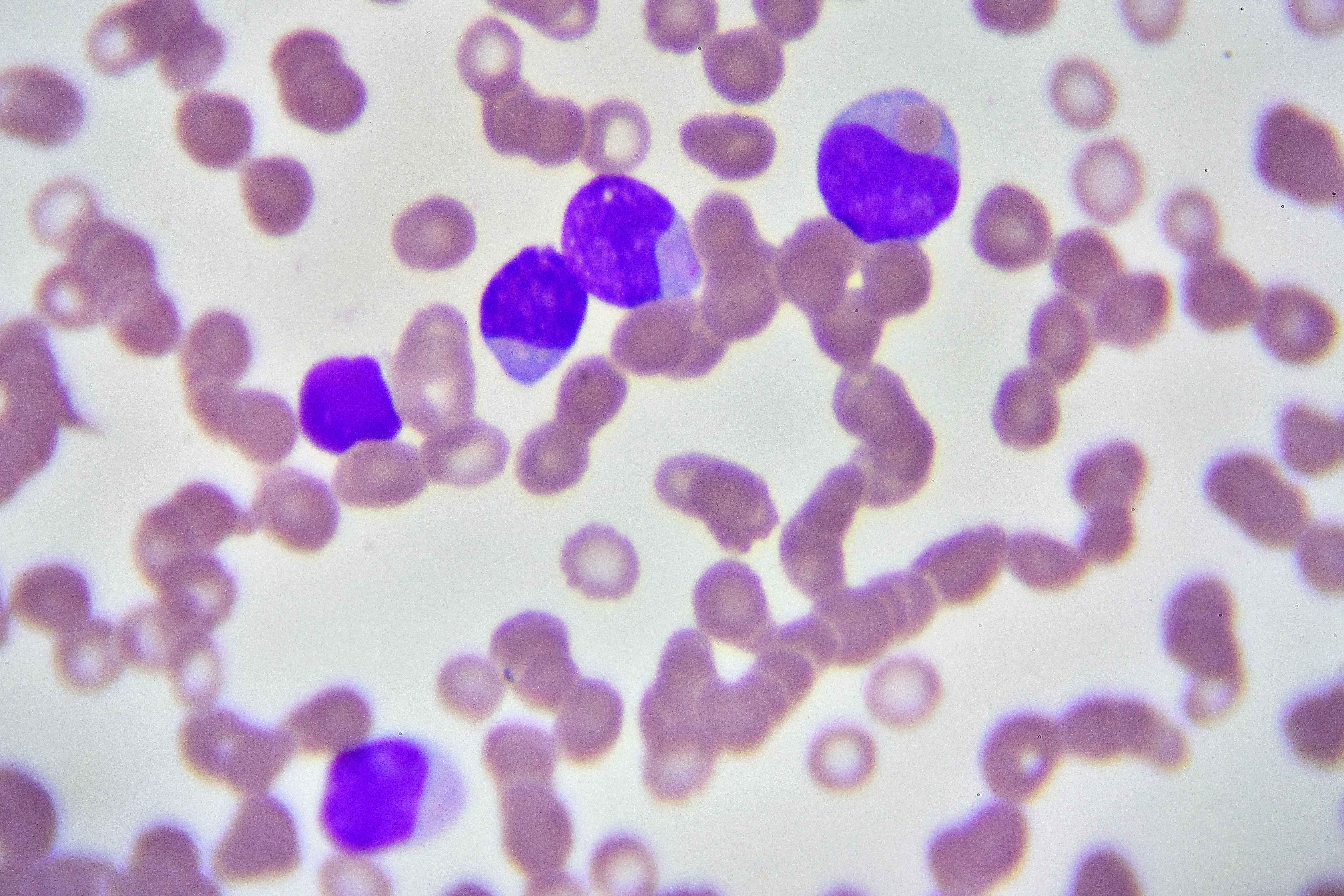 leukemia