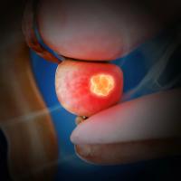 Grade 2 or higher genitourinary acute toxicity was observed in 27.3% of patients treated with 2 fractions of SBRT vs 29.2% of patients treated with 5.
