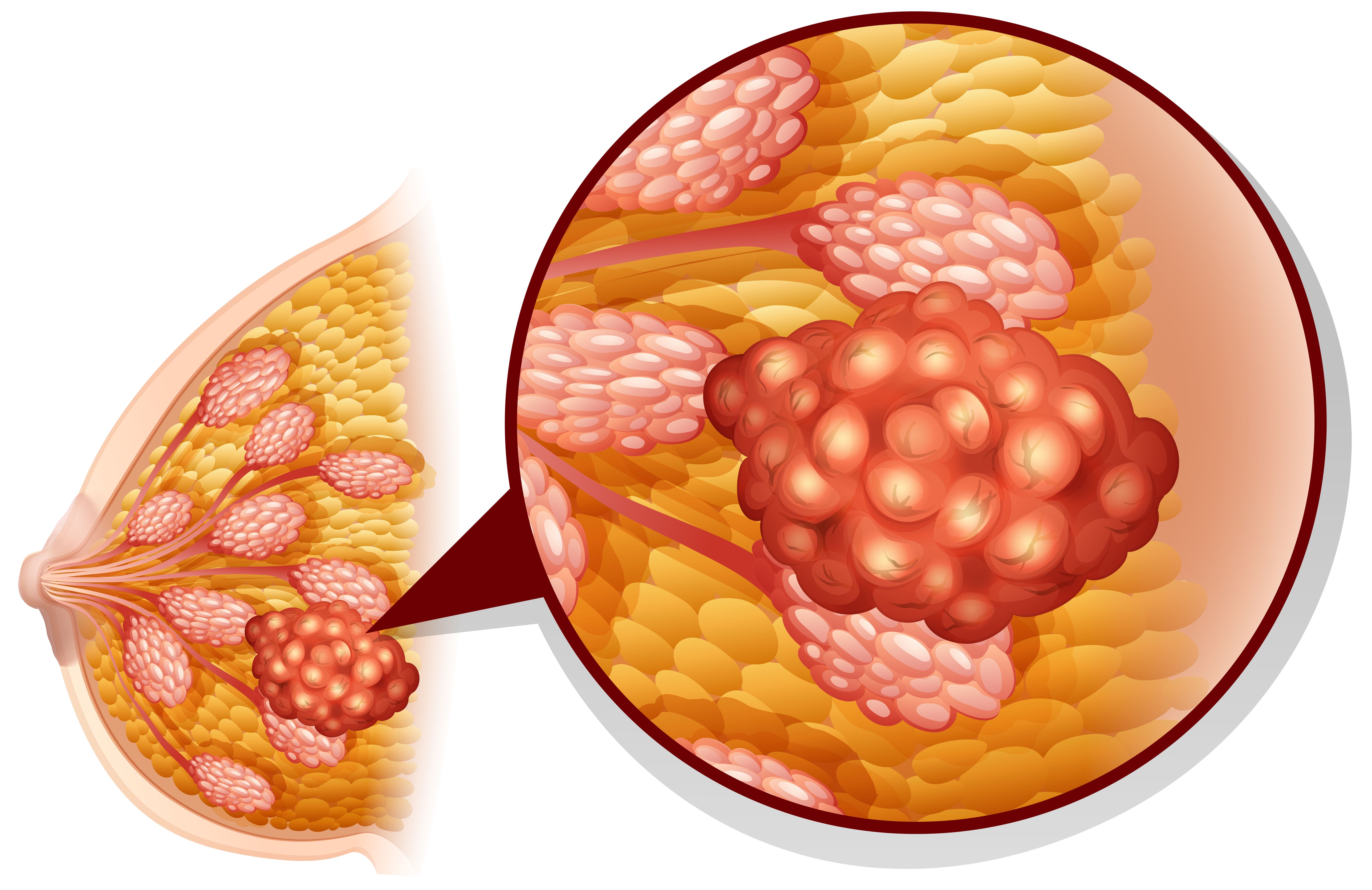 No treatment-related discontinuations have been observed related to Bria-IMT treatment for hormone receptor–positive breast cancer.