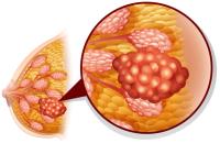 The risk of pain deterioration was similar with T-DXd/pertuzumab vs standard of care in the DESTINY-Breast09 trial.