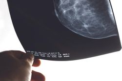 MammoScreen AI Tool Improves Diagnostic Performance of Radiologists in Detecting Breast Cancer