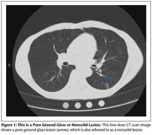 Low-Dose Spiral CT Screening and Evaluation of the Solitary Pulmonary Nodule  