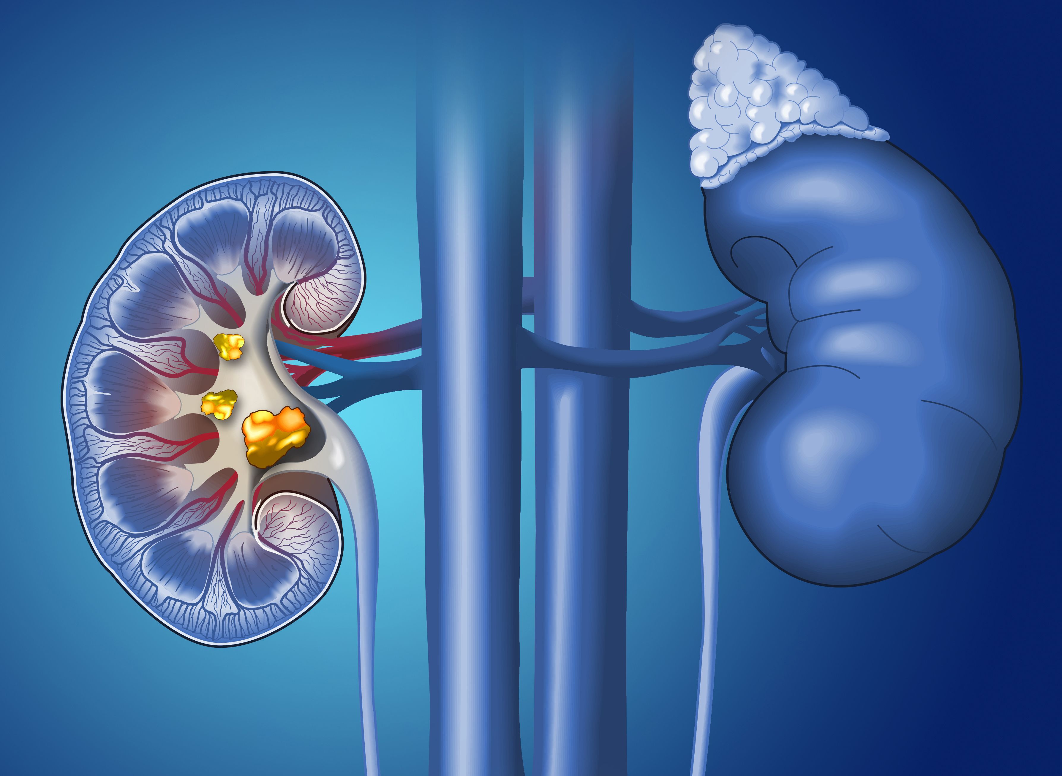 Clinicians Consider Identification, Management of RCC Through the ...