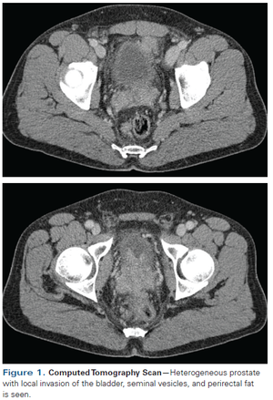 Man With Locally Advanced, High-Risk Prostate Cancer Asks About Adding Chemotherapy to His Treatment