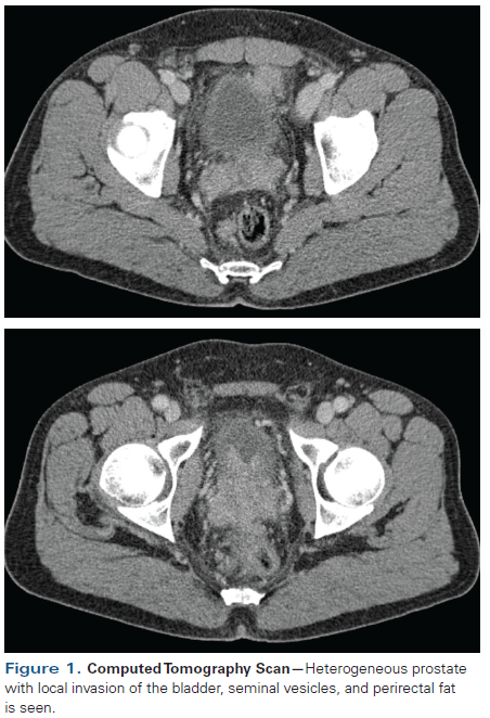 heterogeneous prostate on ct scan
