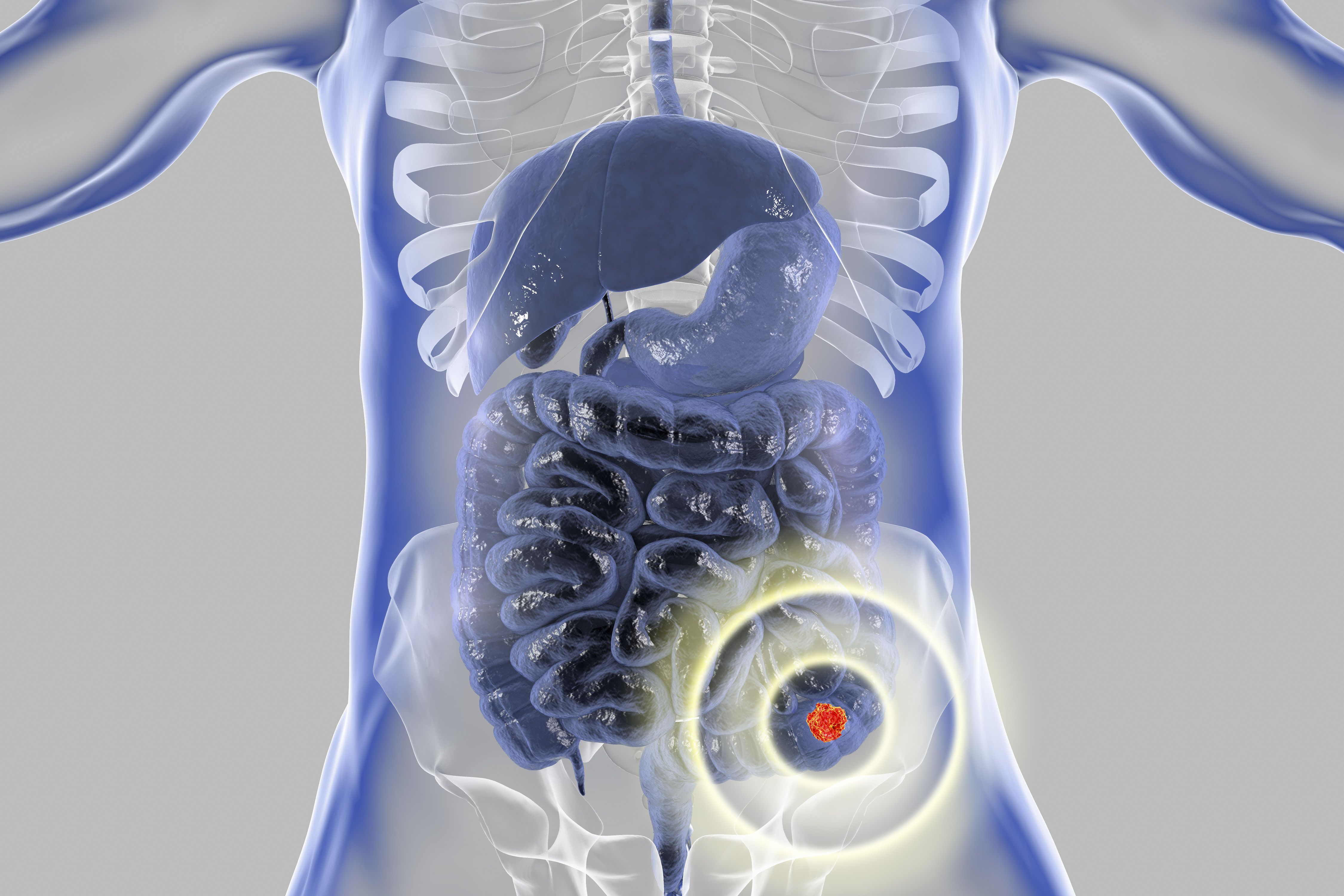 In January 2025, the FDA approved sotorasib/panitumumab for patients with KRAS G12C-mutated CRC based on prior findings from the CodeBreaK 300 trial.