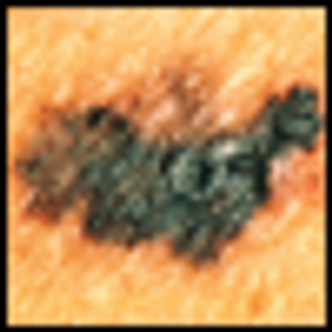 ASCO 2011: New Hope for Metastatic Melanoma