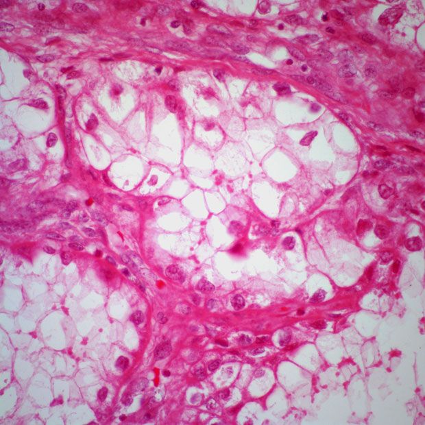 Adavosertib does not appear to be well tolerated in patients with previously treated recurrent or persistent uterine serous carcinoma in the phase 2b ADAGIO trial.
