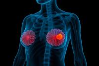 3D medical illustration showing breast cancer in human female body with highlighted tumor inside breast tissue, used for oncology awareness, diagnostics, and health education: © Ram - stock.adobe.com