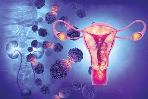 Oncologists explore the considerations of mirvetuximab soravtansine treatment in platinum-resistant ovarian cancer, highlighting its efficacy and the management of ocular AEs.