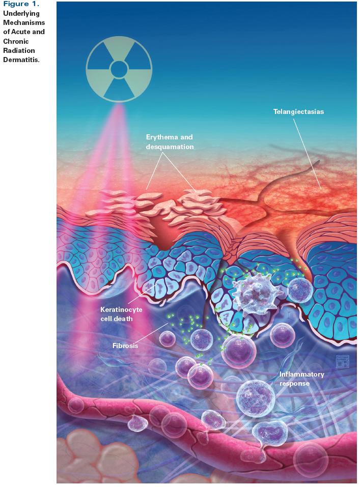 Radiation Dermatitis: Recognition, Prevention, and Management