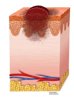 What to Do When Anti–PD-1 Therapy Fails in Patients With Melanoma