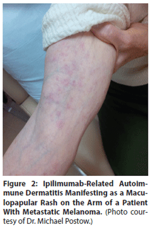 Identification and Management of Toxicities From Immune Checkpoint–Blocking Drugs