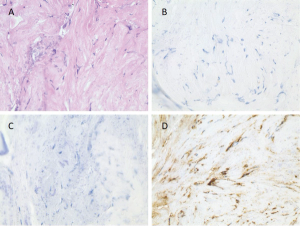 Erdheim-Chester Disease: A Case Report of BRAF V600E–Negative, MAP2K1-Positive ECD Diagnosed by Blood Next-Generation Sequencing Assay and a Brief Literature Review