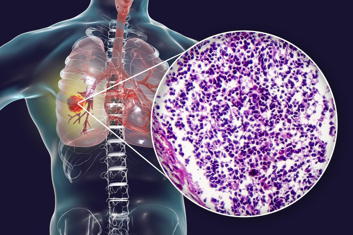 La radioterapia en dosis altas más quimioterapia es eficaz en el cáncer de pulmón de células no pequeñas localmente avanzado