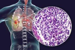 Mobocertinib Receives Approval in China for Previously Treated EGFR Exon 20 Insertion–Mutated NSCLC