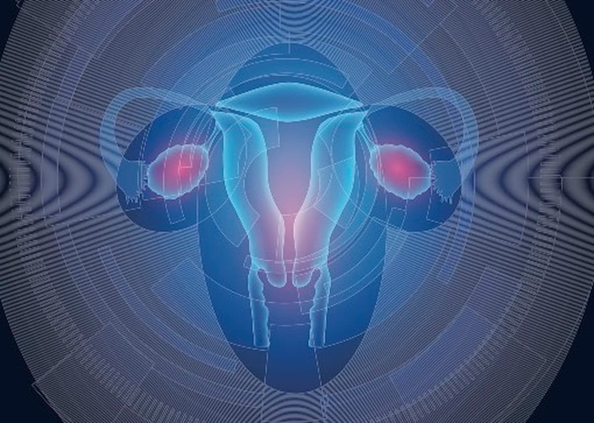 Treatment with pembrolizumab plus chemotherapy with or without bevacizumab yields an overall survival improvement regardless of squamous or nonsquamous cervical cancer histology.