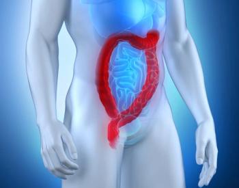 Treatment with complete mesocolic excision appears to reduce the length of hospital stay compared with conventional surgery in right colon cancer.
