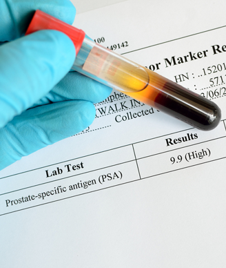 Model Using Psa Test Can Help Predict Time To Prostate Cancer Relapse Model Using Psa Test Can Help Predict Time To Prostate Cancer Relapse