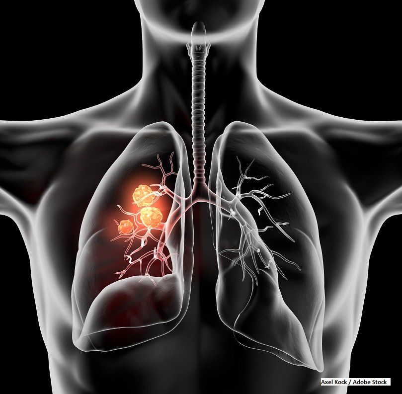 new-developments-in-neoadjuvant-therapy-for-lung-cancer