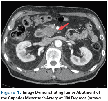 Pancreatic cancer ct scan