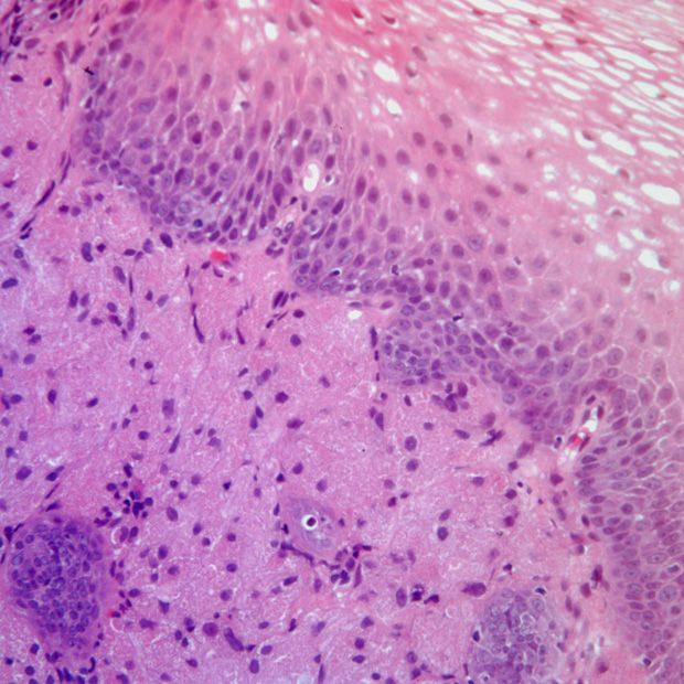 La clasificación de los ganglios linfáticos puede ayudar a predecir el cáncer de esófago