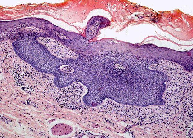 Slide Show: Melanoma and Other Skin Cancers