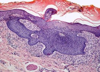 The 31-gene expression profile test appears to allow for significant and independent risk stratification of those with stage I cutaneous melanoma.