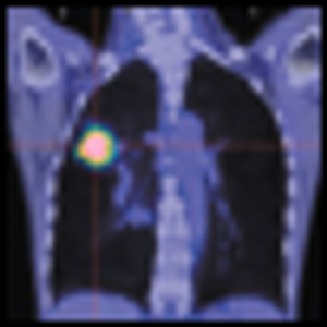 Serum Test IDs Lung Cancer in Never Smokers