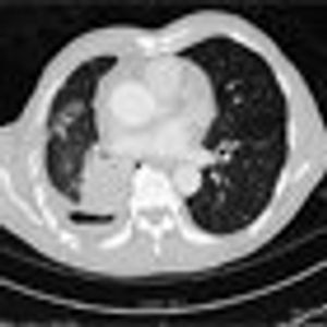 Double Trouble: A Case of Concurrent De Novo T790M and L858R EGFR Mutations in Treatment-Naive Advanced Non–Small-Cell Lung Cancer